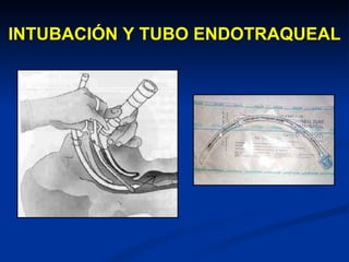 INTUBACIÓN Y TUBO ENDOTRAQUEAL 