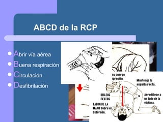 ABCD de la RCP A brir vía aérea B uena respiración C irculación D esfibrilación