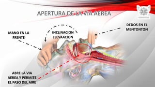 MANO EN LA
FRENTE
DEDOS EN EL
MENTONTON
INCLINACION
ELEVAACION
ABRE LA VIA
AEREA Y PERMITE
EL PASO DEL AIRE
 