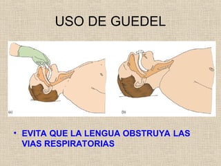 USO DE GUEDEL
• EVITA QUE LA LENGUA OBSTRUYA LAS
VIAS RESPIRATORIAS
 