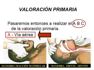 MANIOBRA FRENTE - MENTÓNMANIOBRA TRACCIÓN MANDIBULAR
 