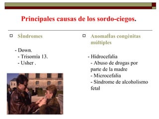 Principales causas de los sordo-ciegos . Síndromes - Down.  - Trisomía 13.  - Usher .  Anomalías congénitas múltiples - Hidrocefalia  - Abuso de drogas por parte de la madre  - Microcefalia  - Síndrome de alcoholismo fetal  