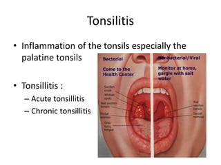 Tonsilitis
• Inflammation of the tonsils especially the
palatine tonsils
• Tonsillitis :
– Acute tonsillitis
– Chronic tonsillitis
 