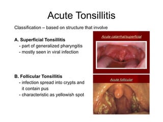 Acute Tonsillitis
Classification – based on structure that involve
A. Superficial Tonsillitis
- part of generalized pharyngitis
- mostly seen in viral infection
B. Follicular Tonsillitis
- infection spread into crypts and
it contain pus
- characteristic as yellowish spot
 