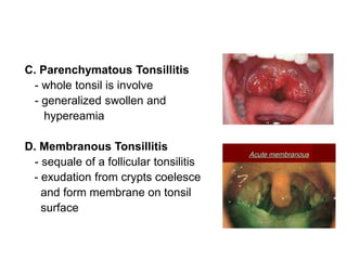 C. Parenchymatous Tonsillitis
- whole tonsil is involve
- generalized swollen and
hypereamia
D. Membranous Tonsillitis
- sequale of a follicular tonsilitis
- exudation from crypts coelesce
and form membrane on tonsil
surface
 