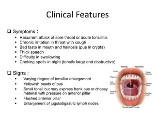 Clinical Features
 Symptoms :
 Recurrent attack of sore throat or acute tonsillitis
 Chronic irritation in throat with cough
 Bad taste in mouth and halitosis (pus in crypts)
 Thick speech
 Difficulty in swallowing
 Choking spells in night (tonsils large and obstructive)
 Signs :
 Varying degree of tonsillar enlargement
 Yellowish beads of pus
 Small tonsil but may express frank pus or cheesy
material with pressure on anterior pillar
 Flushed anterior pillar
 Enlargement of jugulodigastric lymph nodes
 