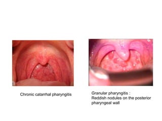 Chronic catarrhal pharyngitis Granular pharyngitis :
Reddish nodules on the posterior
pharyngeal wall
 