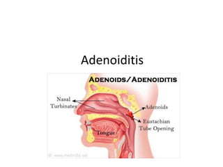 Adenoiditis
 