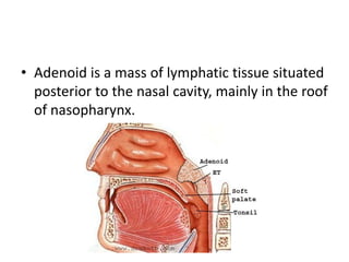 • Adenoid is a mass of lymphatic tissue situated
posterior to the nasal cavity, mainly in the roof
of nasopharynx.
 