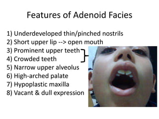 Features of Adenoid Facies
1) Underdeveloped thin/pinched nostrils
2) Short upper lip --> open mouth
3) Prominent upper teeth
4) Crowded teeth
5) Narrow upper alveolus
6) High-arched palate
7) Hypoplastic maxilla
8) Vacant & dull expression
 