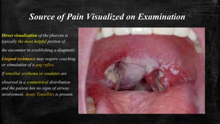 Source of Pain Visualized on Examination
Direct visualization of the pharynx is
typically the most helpful portion of
the encounter in establishing a diagnosis.
Lingual resistance may require coaching
or stimulation of a gag reflex.
If tonsillar erythema or exudates are
observed in a symmetrical distribution
and the patient has no signs of airway
involvement, Acute Tonsillitis is present.
 