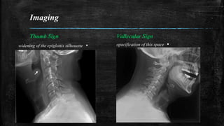 Imaging
Thumb Sign
▪widening of the epiglottis silhouette
Vallecular Sign
▪opacification of this space
 