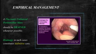 EMPIRICAL MANAGEMENT
A Fluctuant Unilateral
Peritonsillar Mass
should be DRAINED
whenever possible.
Drainage in such cases
constitutes definitive care.
 