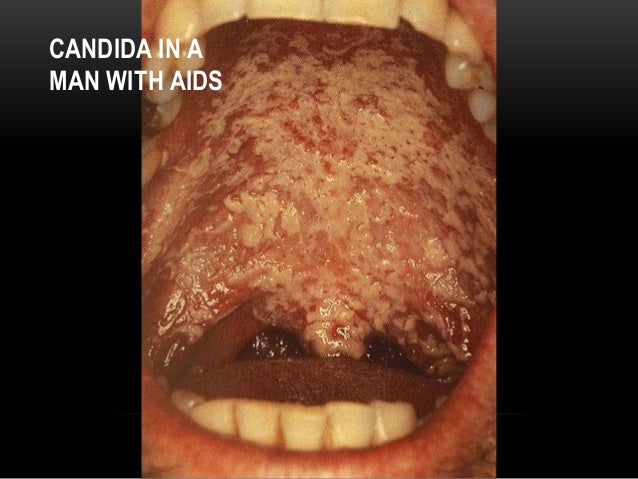 gonorrhea symptoms sore throat