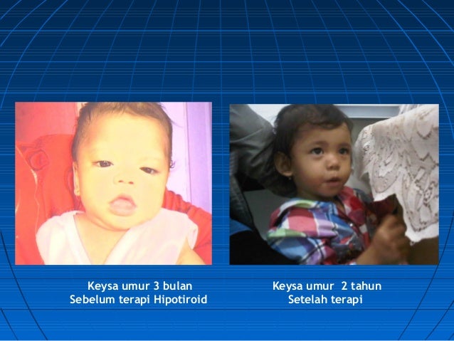 Skrining Bayi Baru Lahir Hipotiroid Kongenital - Sosialisasi Kalimant…