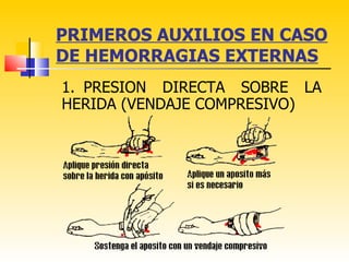 PRIMEROS AUXILIOS EN CASO
DE HEMORRAGIAS EXTERNAS
1. PRESION DIRECTA SOBRE LA
HERIDA (VENDAJE COMPRESIVO)
 
