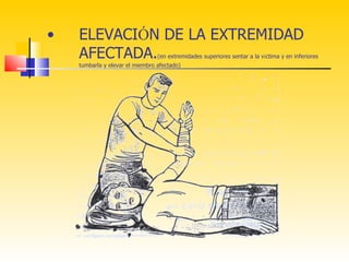 •   ELEVACIÓN DE LA EXTREMIDAD
    AFECTADA.                    (en extremidades superiores sentar a la víctima y en inferiores
    tumbarla y elevar el miembro afectado)
 