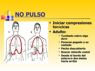 NO PULSO
              Iniciar compresiones
               torácicas
              Adulto:
                     Tumbado sobre algo
                      duro
                     Ponerse pegado a su
                      costado
                     Pecho descubierto
                     Buscar reborde costal
                     Desde el borde del
                      esternón dos dedos
                      hacia arriba
 