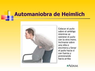 Automaniobra de Heimlich
 
