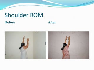 Shoulder ROM
Before         After
 