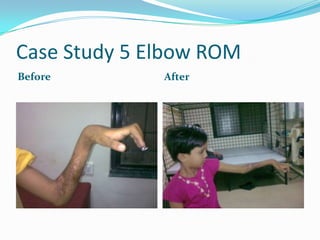 Case Study 5 Elbow ROM
Before        After
 