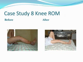 Case Study 8 Knee ROM
Before        After
 