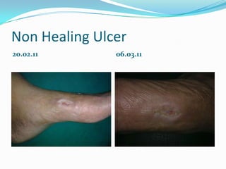 Non Healing Ulcer
20.02.11       06.03.11
 