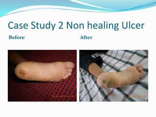 Case Study 2 Non healing Ulcer
Before         After
 