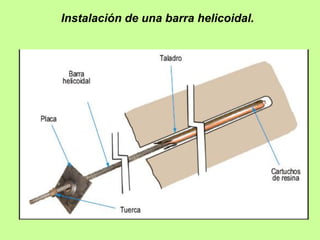 Instalación de una barra helicoidal.
 