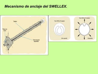 Mecanismo de anclaje del SWELLEX.
 