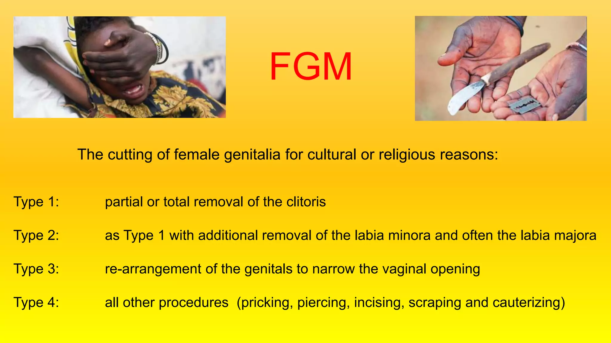 FGM
The cutting of female genitalia for cultural or religious reasons:
Type 1: partial or total removal of the clitoris
Type 2: as Type 1 with additional removal of the labia minora and often the labia majora
Type 3: re-arrangement of the genitals to narrow the vaginal opening
Type 4: all other procedures (pricking, piercing, incising, scraping and cauterizing)
 