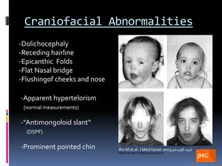 Sotos syndrome, Genetics, Radiology, Craniofacial Abnormalities