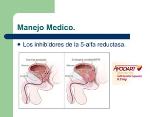 Manejo Medico. Los inhibidores de la 5-alfa reductasa. 