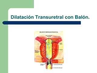 Dilatación Transuretral con Balón. 