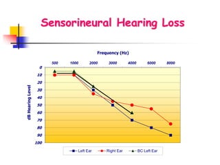 0
10
20
30
40
50
60
70
80
90
100
500 1000 2000 3000 4000 6000 8000
dBHearingLevel
Frequency (Hz)
Left Ear Right Ear BC Left Ear
Sensorineural Hearing Loss
 