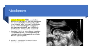 Abodomen
• acalculia cholecystitis POCUS has also been
assessed for the diagnosis of acute cholecystitis
and found to be highly sensitive and specific
(87% and 82%) when the criteria of gallstones
plus an additional finding of a sonographic
Murphy’s sign, gallbladder wall thickness, or
pericholecystic fluid is used for assessment.
• Results of POCUS for biliary disease have been
shown to be similarly accurate to findings of
radiologist performed ultrasounds (sensitivity
83% and specificity 86%).
• Hilsden R, et al. Trauma Surg Acute Care Open 2018;3:e000164.
doi:10.1136/tsaco-2018-000164
 
