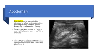 Abodomen
• Diverticulitis can be appreciated on
ultrasound by colonic oedema, sometimes
producing an image called the “pseudo
kidney” sign (as it resembles a kidney).
• There are few reports on use of POCUS for
diverticulitis; however, it can be useful as a
rule in test
• Abboud ME, Frasure SE, Stone MB. Ultrasound
diagnosis of diverticulitis. World J Emerg Med.
2016;7(1):74-6.
 