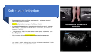Soft tissue infection
• Musculoskeletal POCUS is the next step, especially if no obvious source of
infection has yet been identified.
• Cellulitis is the most common type of soft tissue infection.
• A cobblestone-like appearance on ultrasound, although not specific, indicates
inflamed tissue and combined with the clinical examination, can be helpful in
diagnosis of cellulitis.
• In occult abscess, POCUS has been shown to alter patient management in up
to half of patients .
• POCUS can also identify necrotising fasciitis and expedite management.
• Tayal VS, Hasan N, Norton HJ, Tomaszewski CA. The effect of soft- tissue ultrasound on the management of cellulitis
in the emergency department. Acad Emerg Med. 2006;13(4):384-8
 