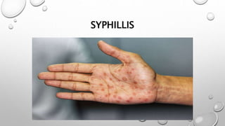 SYPHILLIS
 