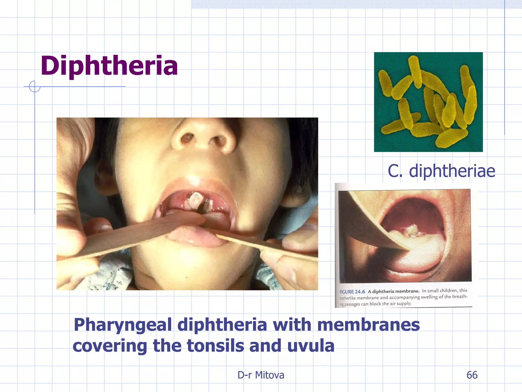 Diphtheria Pharyngeal diphtheria with membranes covering the tonsils and uvula C. diphtheriae 