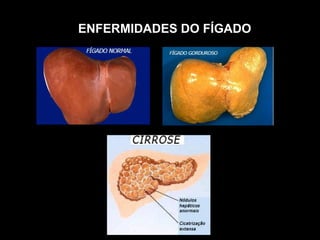 ENFERMIDADES DO FÍGADO 