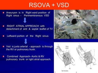 SINUS OF VALSALVA ANEURYSM | PPTX