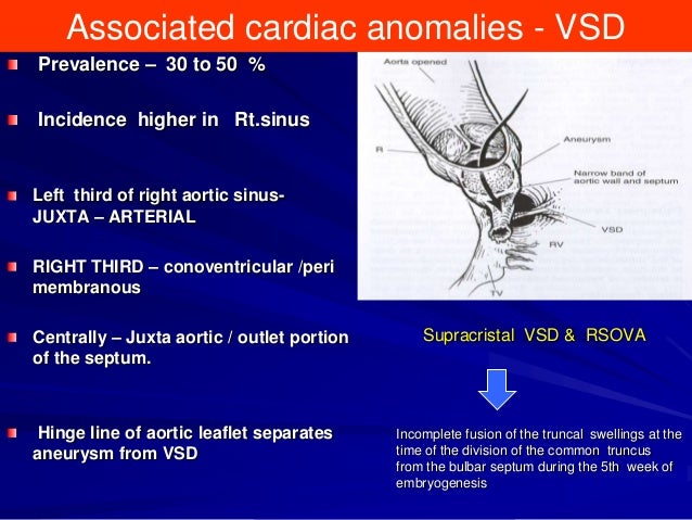 Sinus Of Valsalva Aneurysm