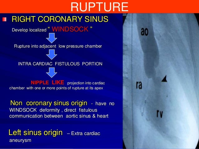 Sinus Of Valsalva Aneurysm
