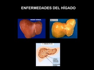 ENFERMEDADES DEL HÍGADO 