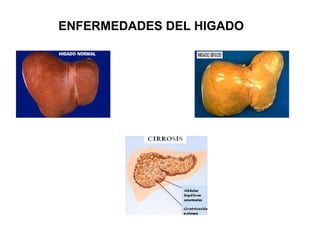 ENFERMEDADES DEL HIGADO   ENFERMEDADES DEL HIGADO 