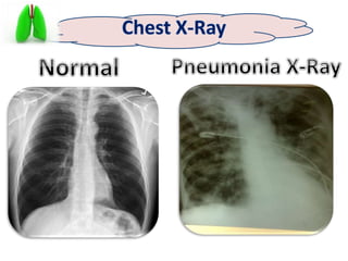 Ventilation Associated Pneumonia [VAP] | PPTX