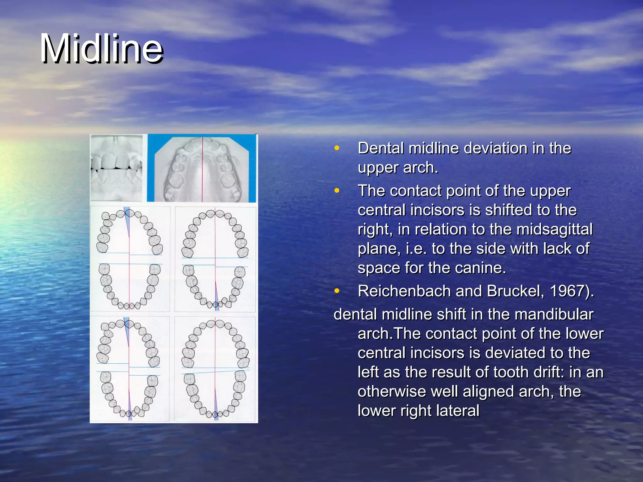 MidlineMidline
• Dental midline deviation in theDental midline deviation in the
upper arch.upper arch.
• The contact point of the upperThe contact point of the upper
central incisors is shifted to thecentral incisors is shifted to the
right, in relation to the midsagittalright, in relation to the midsagittal
plane, i.e. to the side with lack ofplane, i.e. to the side with lack of
space for the canine.space for the canine.
• Reichenbach and Bruckel, 1967).Reichenbach and Bruckel, 1967).
dental midline shift in the mandibulardental midline shift in the mandibular
arch.The contact point of the lowerarch.The contact point of the lower
central incisors is deviated to thecentral incisors is deviated to the
left as the result of tooth drift: in anleft as the result of tooth drift: in an
otherwise well aligned arch, theotherwise well aligned arch, the
lower right laterallower right lateral
 