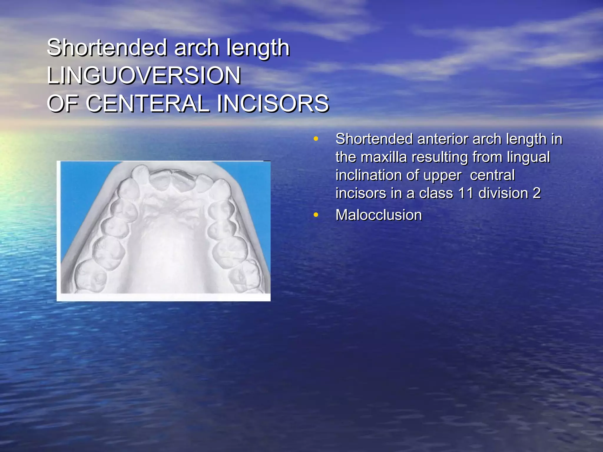 Shortended arch lengthShortended arch length
LINGUOVERSIONLINGUOVERSION
OF CENTERAL INCISORSOF CENTERAL INCISORS
• Shortended anterior arch length inShortended anterior arch length in
the maxilla resulting from lingualthe maxilla resulting from lingual
inclination of upper centralinclination of upper central
incisors in a class 11 division 2incisors in a class 11 division 2
• MalocclusionMalocclusion
 