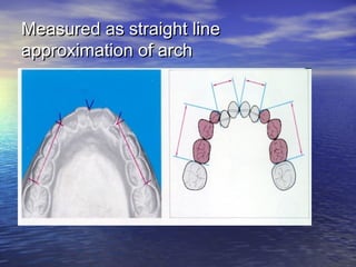 Measured as straight lineMeasured as straight line
approximation of archapproximation of arch
 
